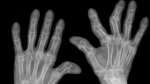 How To Find the Right Drug for Rheumatoid Arthritis