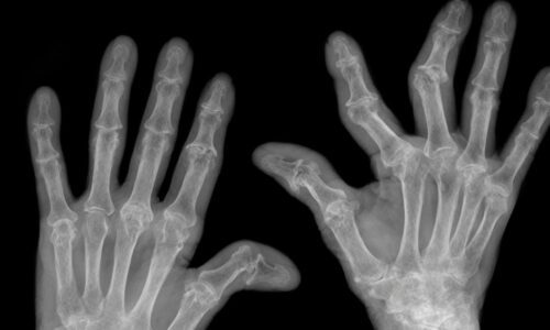 How To Find the Right Drug for Rheumatoid Arthritis