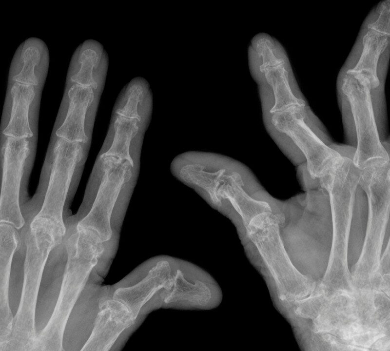 How To Find the Right Drug for Rheumatoid Arthritis