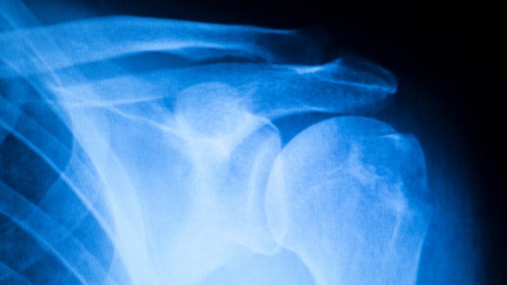 A New Procedure to Repair Shoulder Injuries