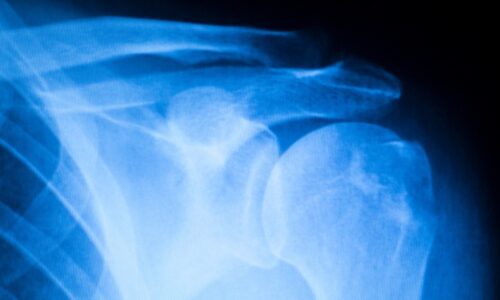 A New Procedure to Repair Shoulder Injuries