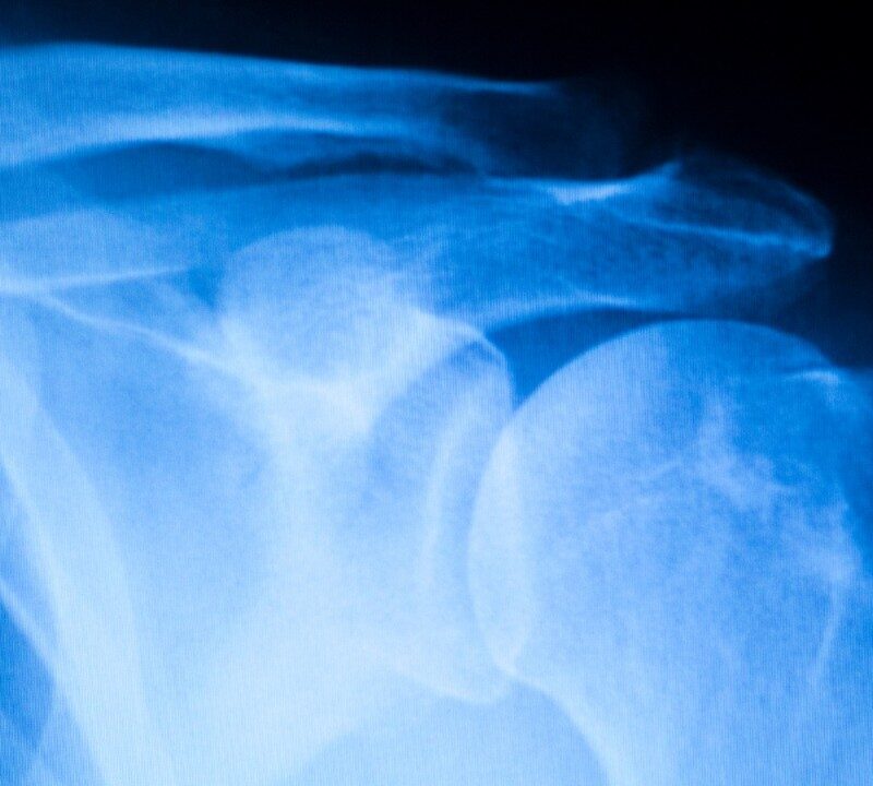 A New Procedure to Repair Shoulder Injuries