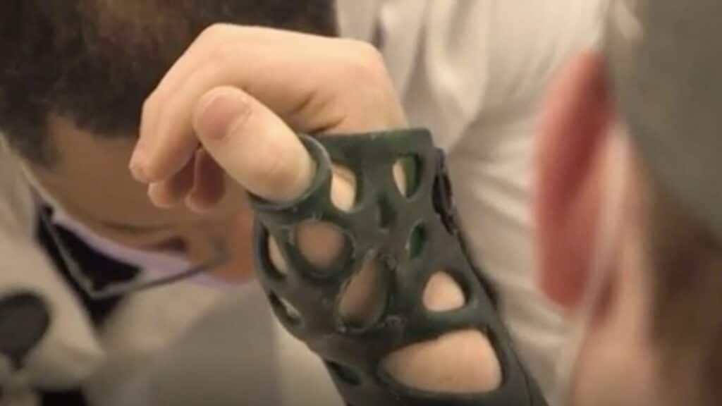 Advantages of 3D Printed Casts