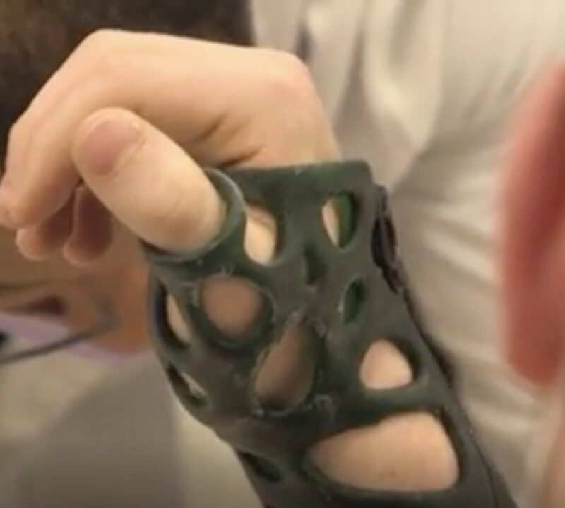 Advantages of 3D Printed Casts