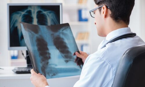 Catching Lung Cancer Early