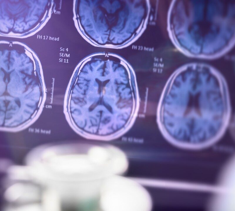 New Alzheimer’s Treatments on the Horizon