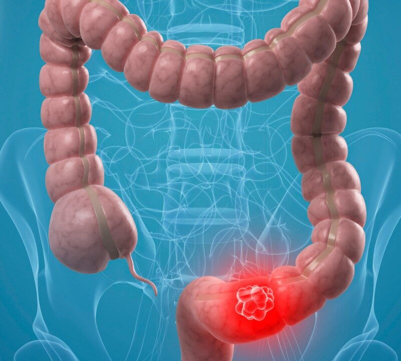 The Importance of Regular Colon Cancer Check Ups