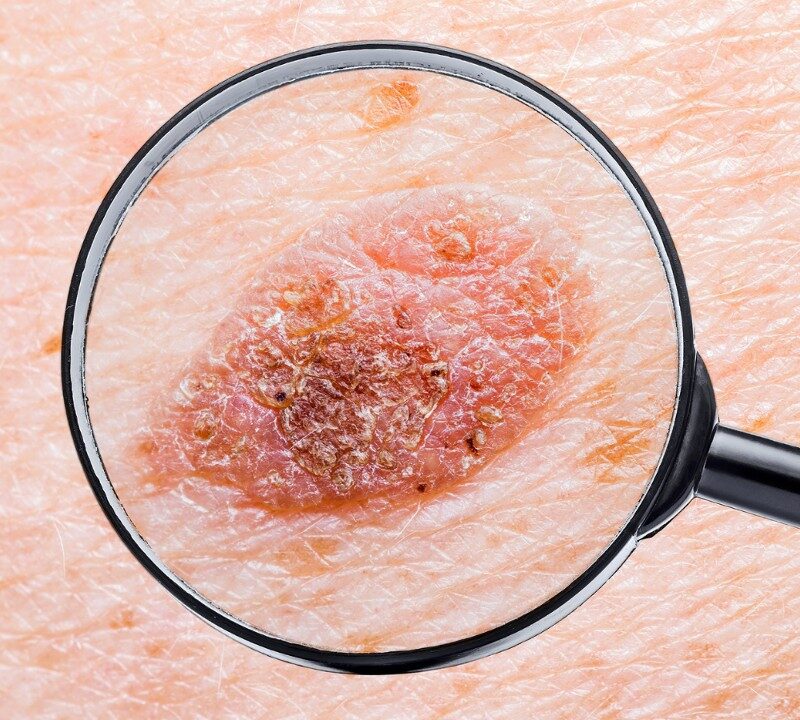 Melanoma Prevention