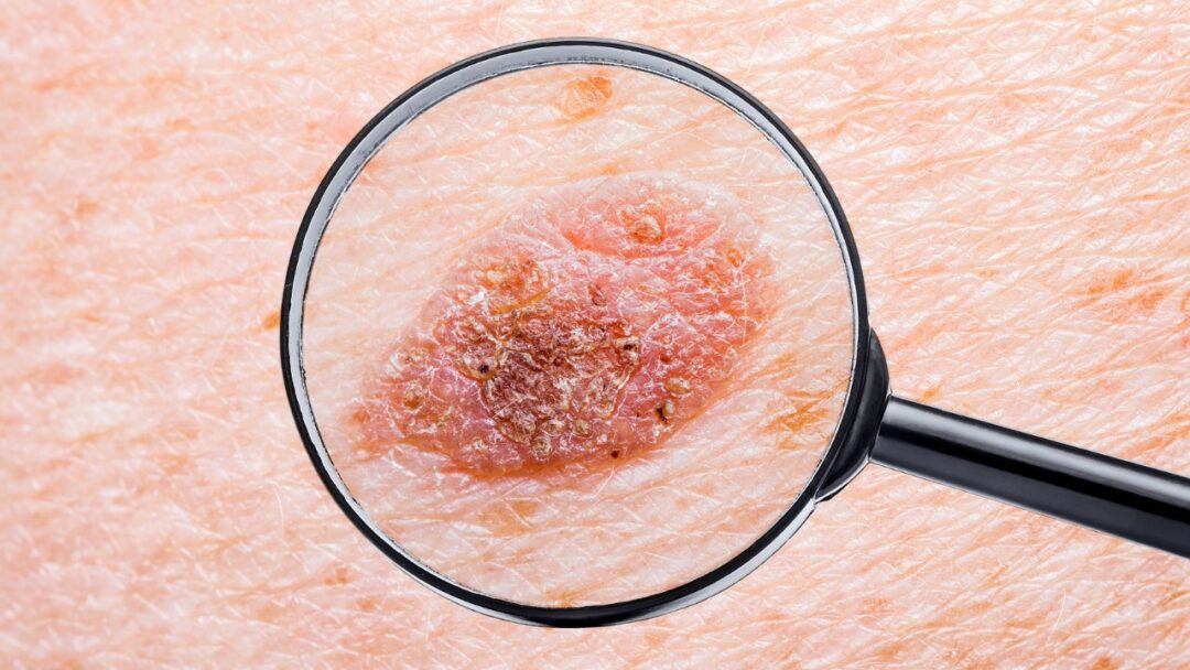 Melanoma Prevention