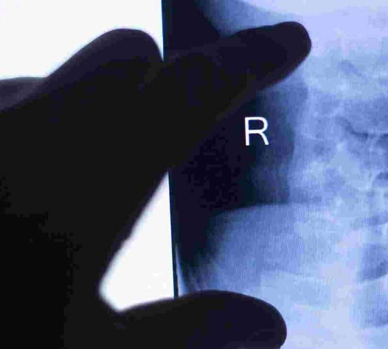 Using Bone Cement to Fix Fractured Vertebra
