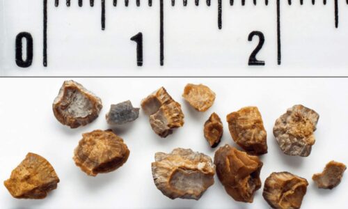How Weather Affects Kidney Stones