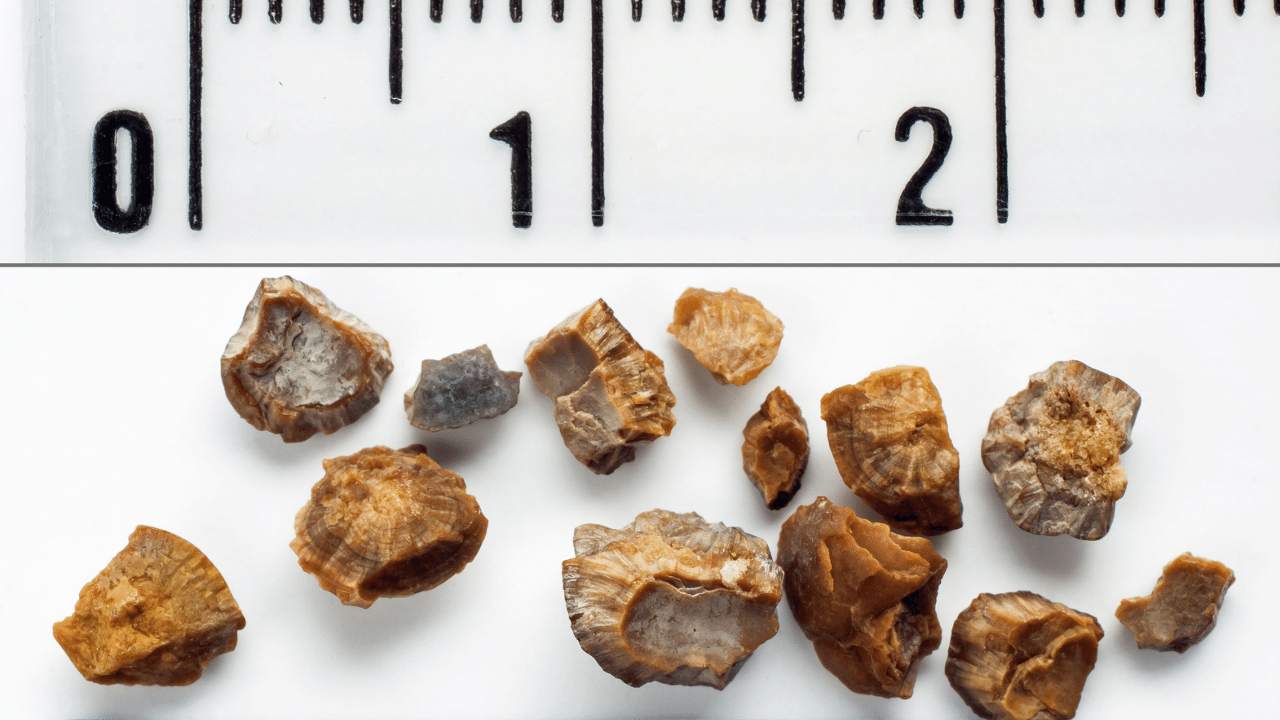 How Weather Affects Kidney Stones