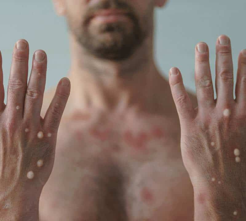 How Can Monkeypox be Prevented?