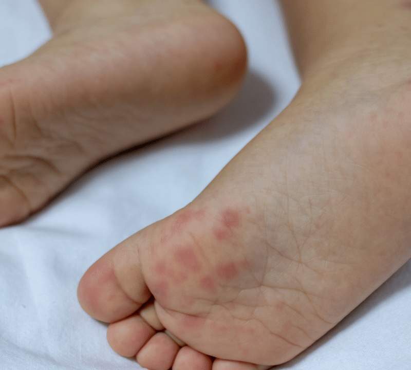 Is Hand Foot and Mouth Disease Contagious to Adults?
