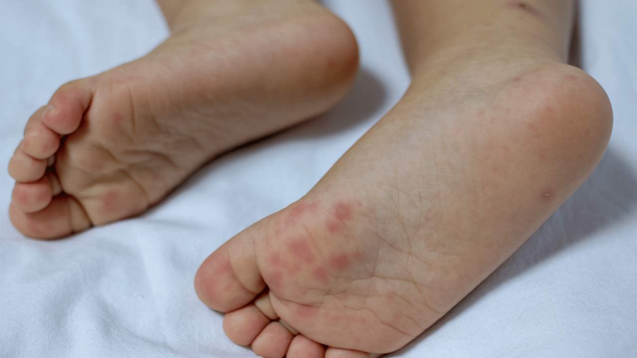 Is Hand Foot and Mouth Disease Contagious to Adults? | Living Minute