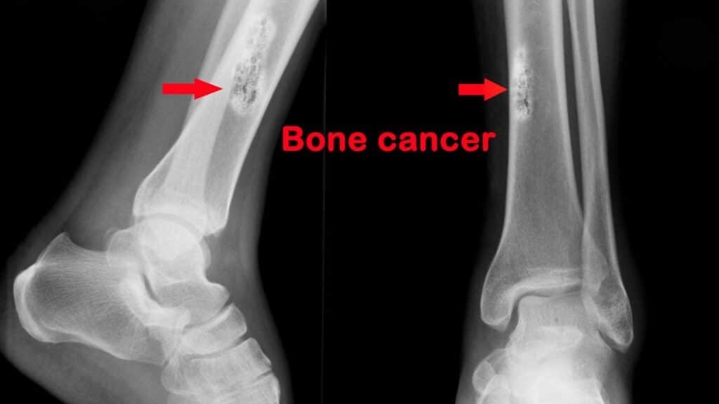 Using Charged Particles to Treat Bone Cancer