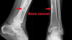 Using Charged Particles to Treat Bone Cancer