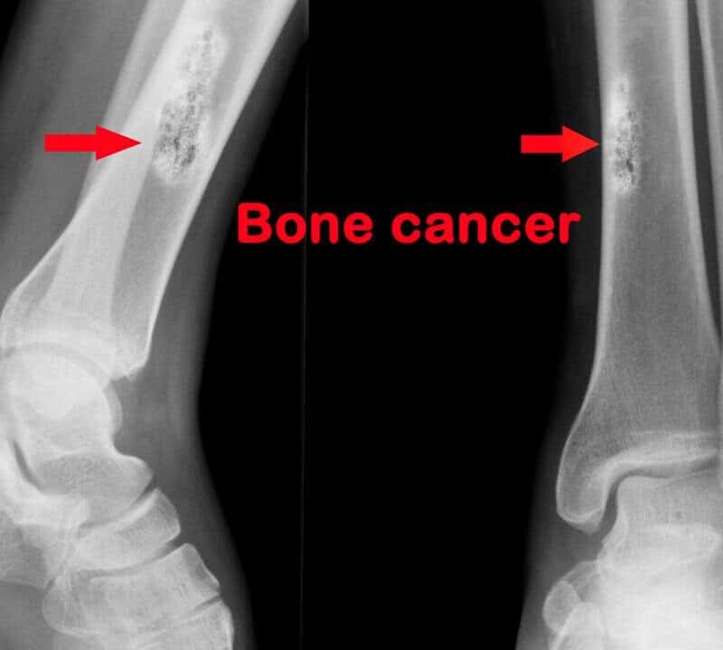 Using Charged Particles to Treat Bone Cancer