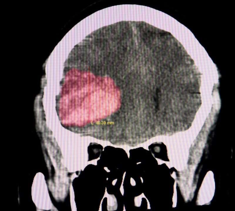 A Little-Known Hemorrhage That Could be Deadly