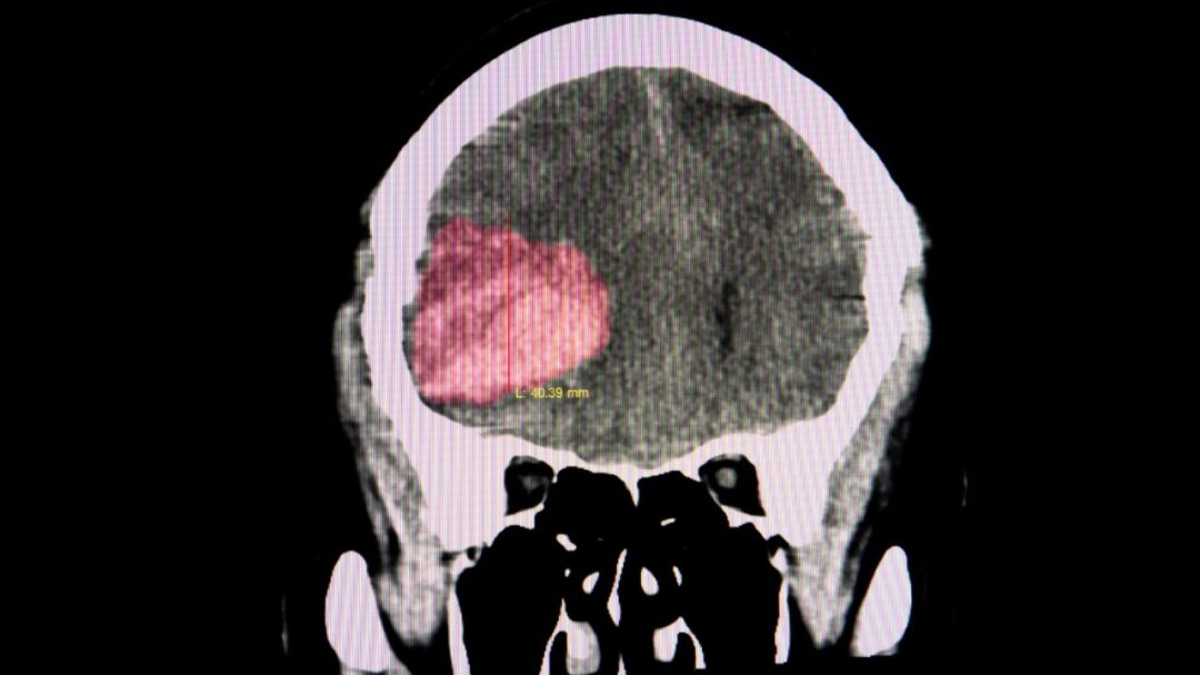 A Little-Known Hemorrhage That Could be Deadly | Living Minute