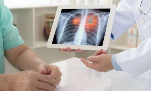 Should You Be Screened for Lung Cancer?