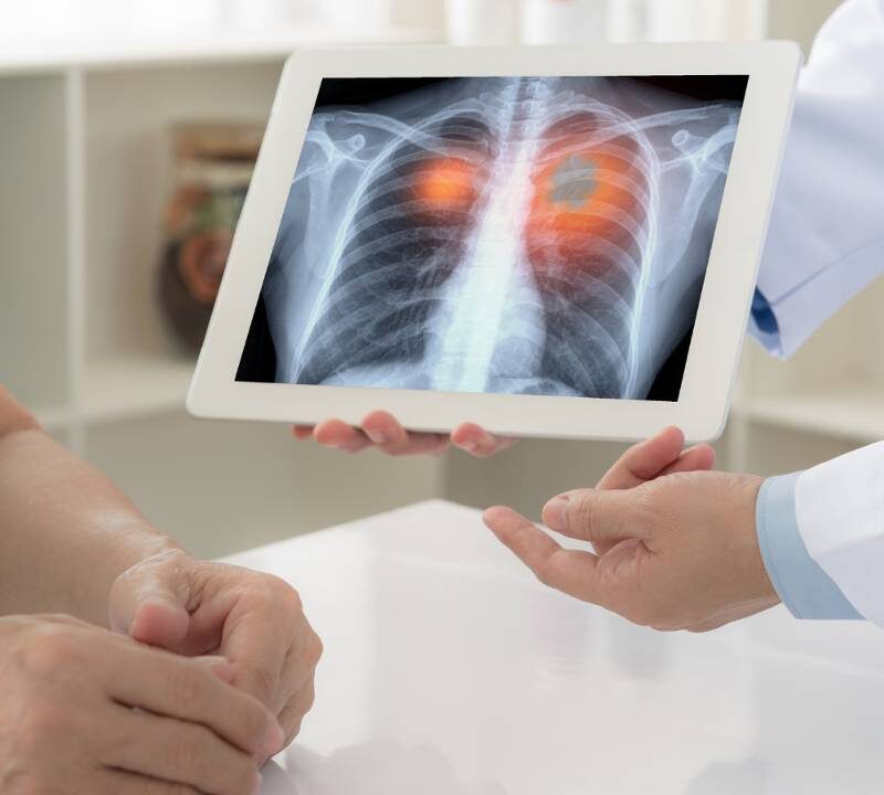 Should You Be Screened for Lung Cancer?