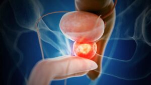 Fighting Aggressive Prostate Cancer with Combination Therapy
