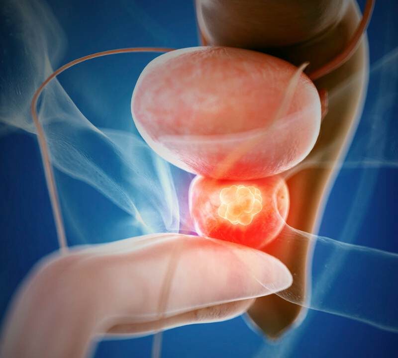Fighting Aggressive Prostate Cancer with Combination Therapy