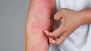 How To Prevent Eczema Flares?