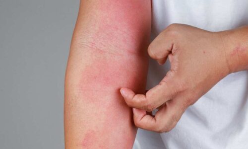 How To Prevent Eczema Flares?