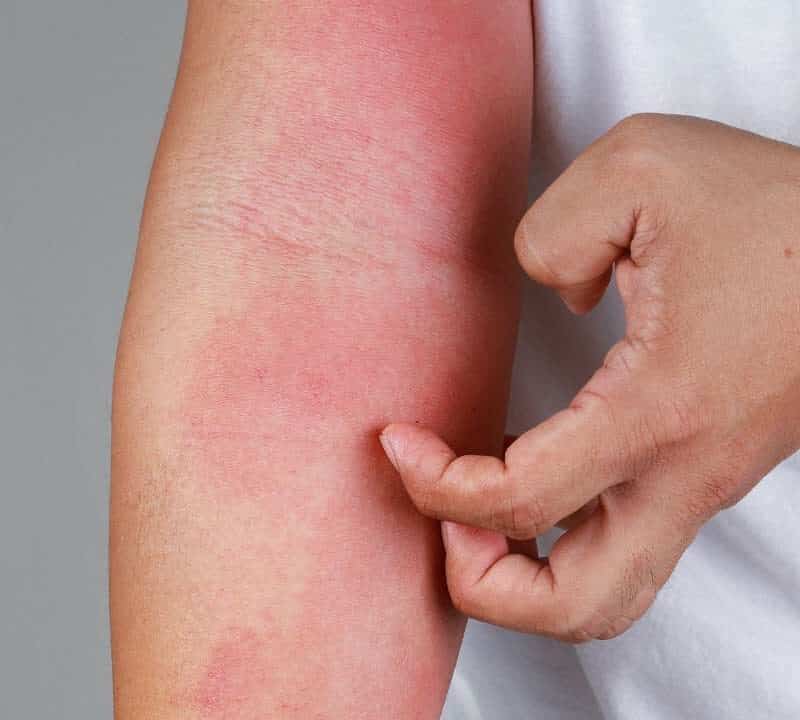 How To Prevent Eczema Flares?