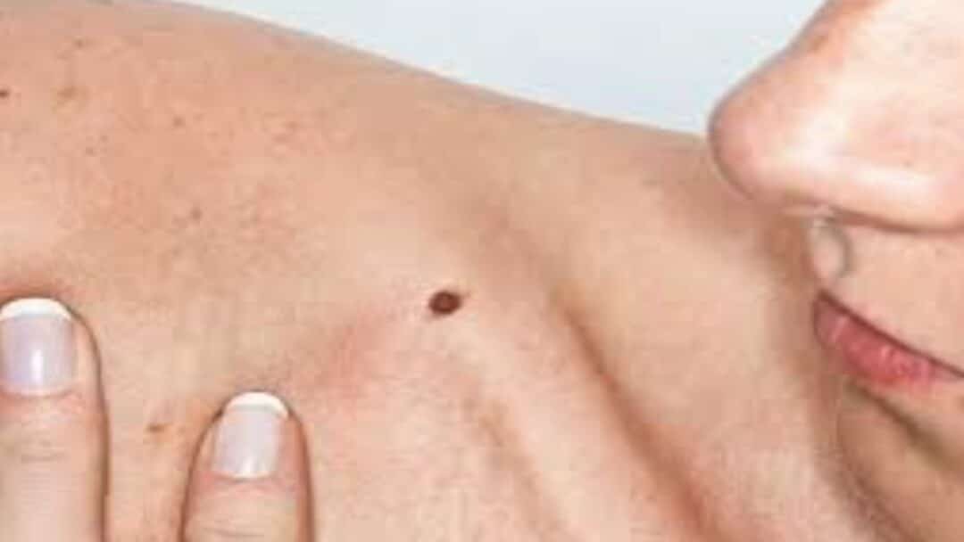The 3 Types of Skin Cancer | Health Channel