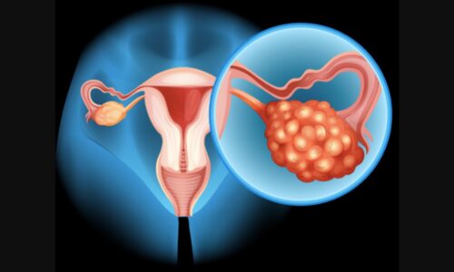 Understanding the Different Types of Ovarian Cancer with Nurse Kristina Rua