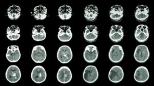 Understanding AVMs and Hemorrhagic Strokes