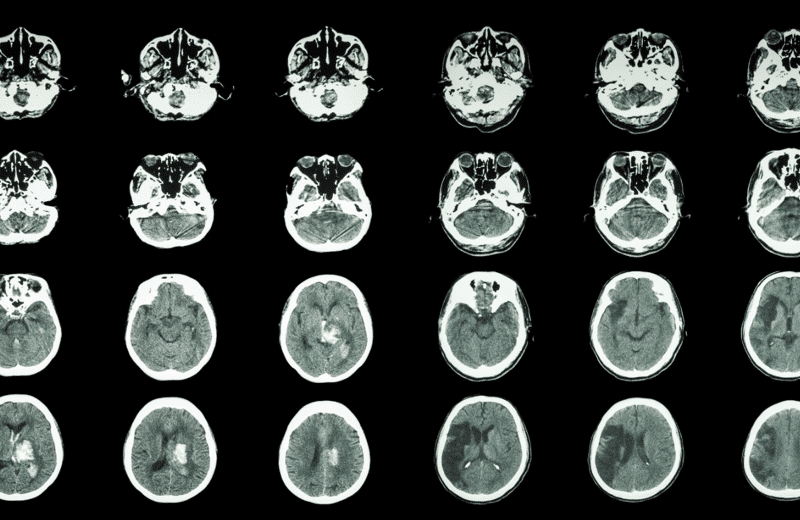 Understanding AVMs and Hemorrhagic Strokes