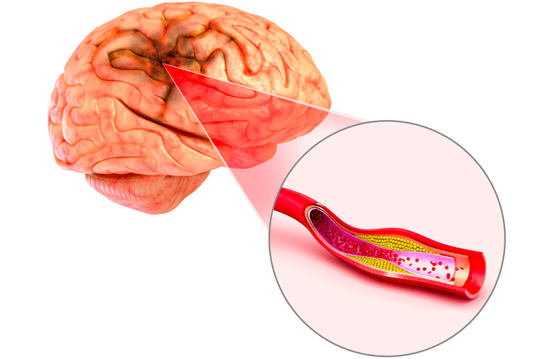 Ischemic and Hemorrhagic Strokes: Understanding the Differences