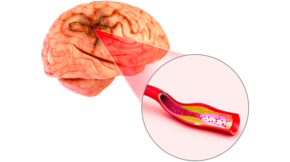 Ischemic and Hemorrhagic Strokes: Understanding the Differences