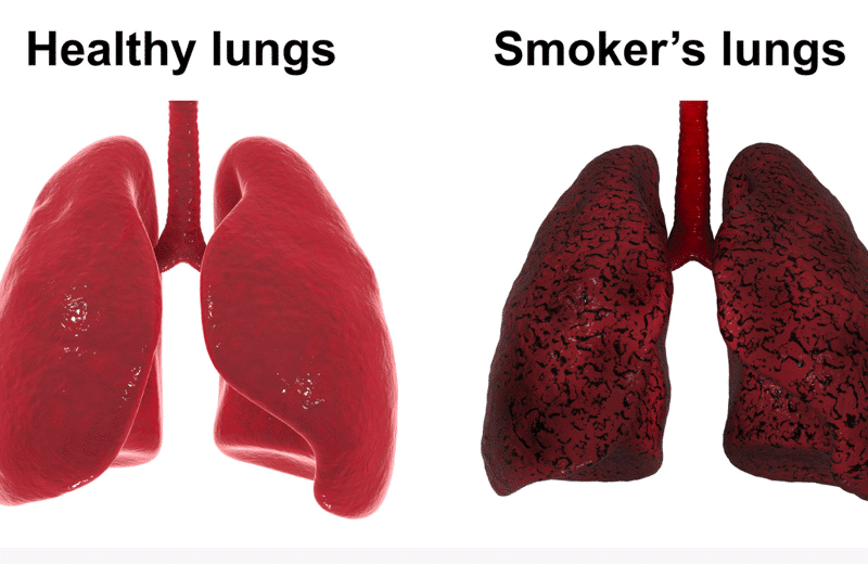 The Damage of Smoking: Examining Smoker’s Lungs