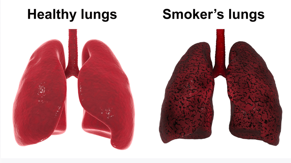 The Damage of Smoking: Examining Smoker's Lungs