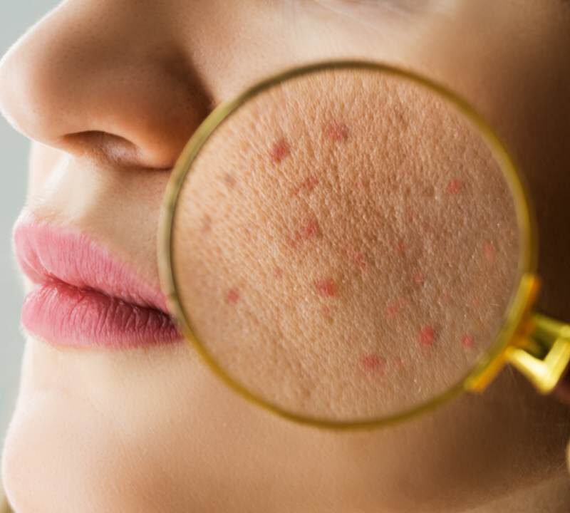 Acne: A Common Skin Condition