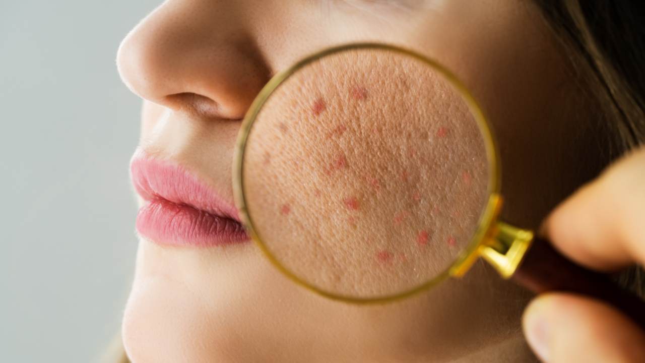 Acne: A Common Skin Condition, Health Channel