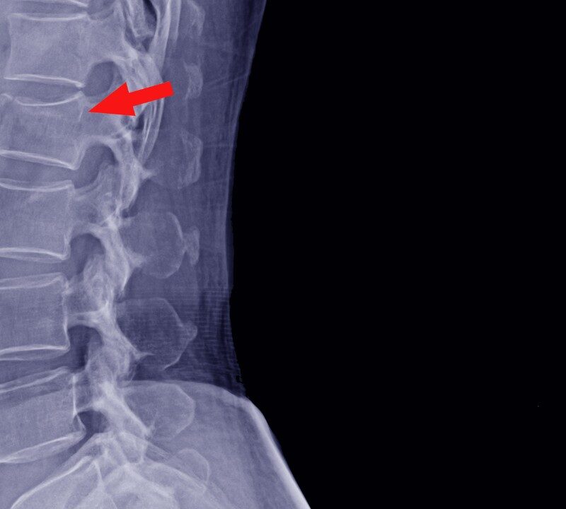 Diagnosing of Spinal Fractures