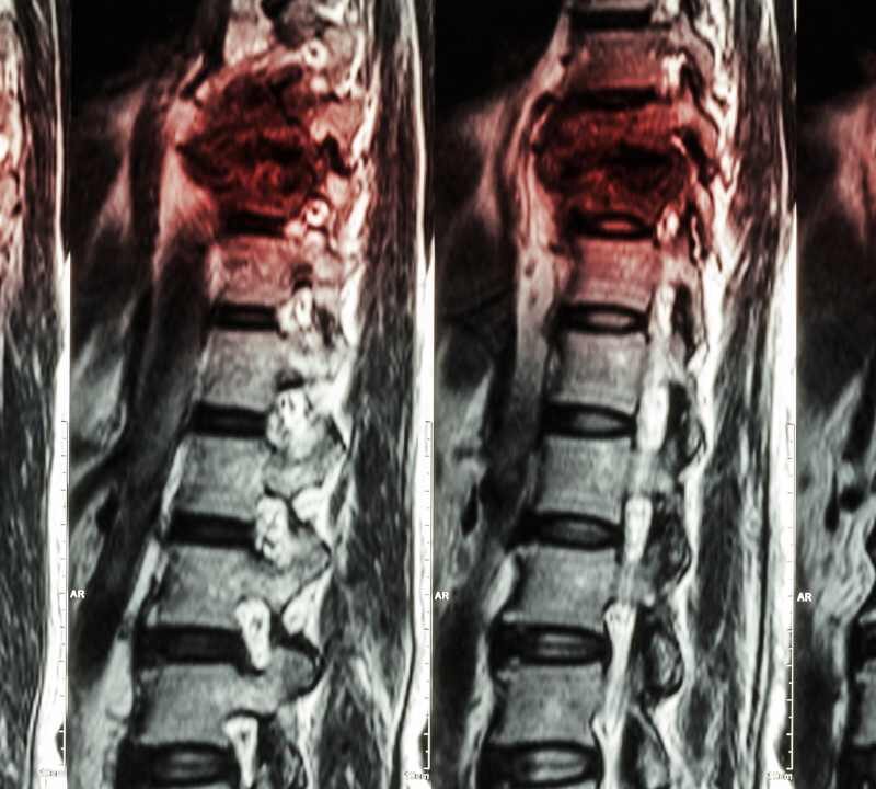 Risk Factors for Compression Fractures: Exploring Gender, Smoking, and Weight