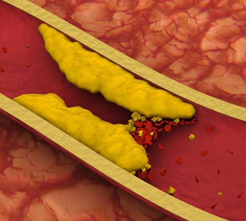 Understanding Arterial Occlusion: The Dangers and Importance of Timely Intervention