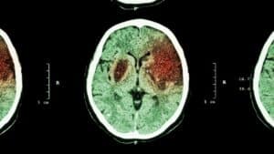 Understanding Ischemic and Hemorrhagic Strokes: Causes and Effects