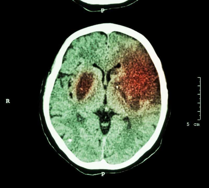 Understanding Ischemic and Hemorrhagic Strokes: Causes and Effects