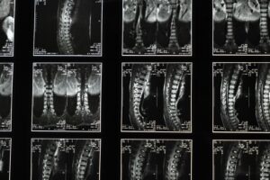 Understanding Scoliosis: Causes, Symptoms, and Treatments