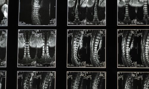 Understanding Scoliosis: Causes, Symptoms, and Treatments