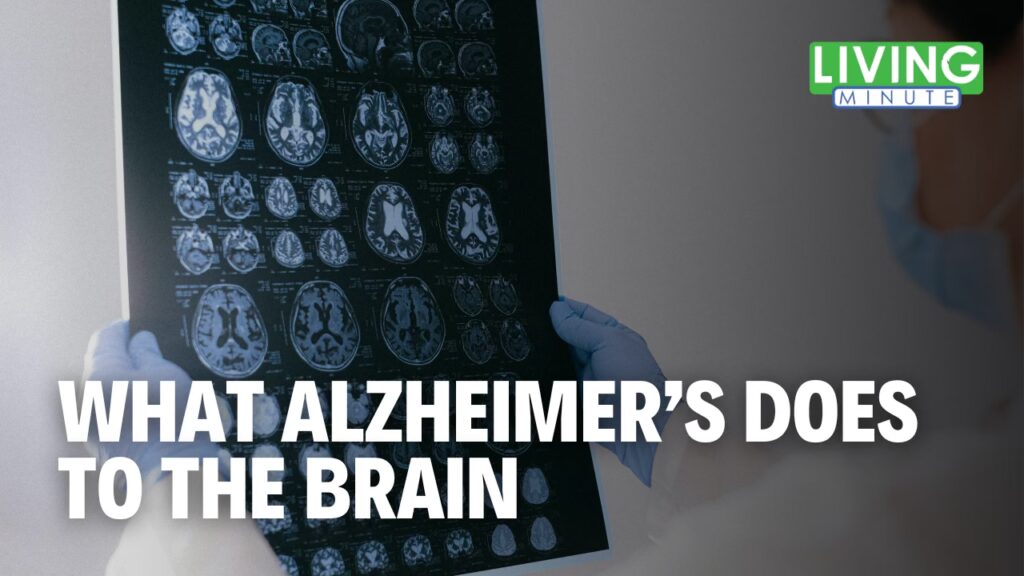 How Alzheimer's Changes the Brain