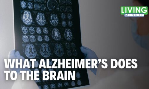 How Alzheimer’s Changes the Brain